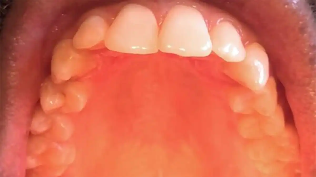 8 Reasons Why The Roof Of Your Mouth Is Itchy