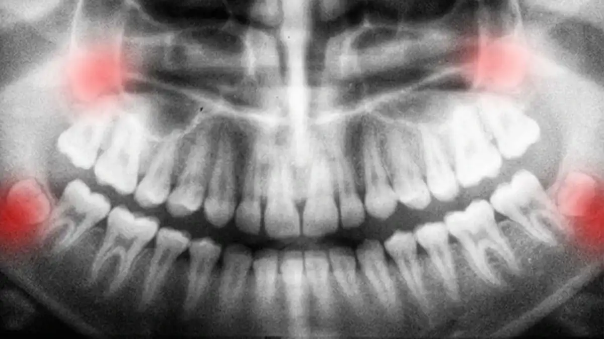 Wisdom Teeth Removal: Pain, Impacted, Recovery & Cost