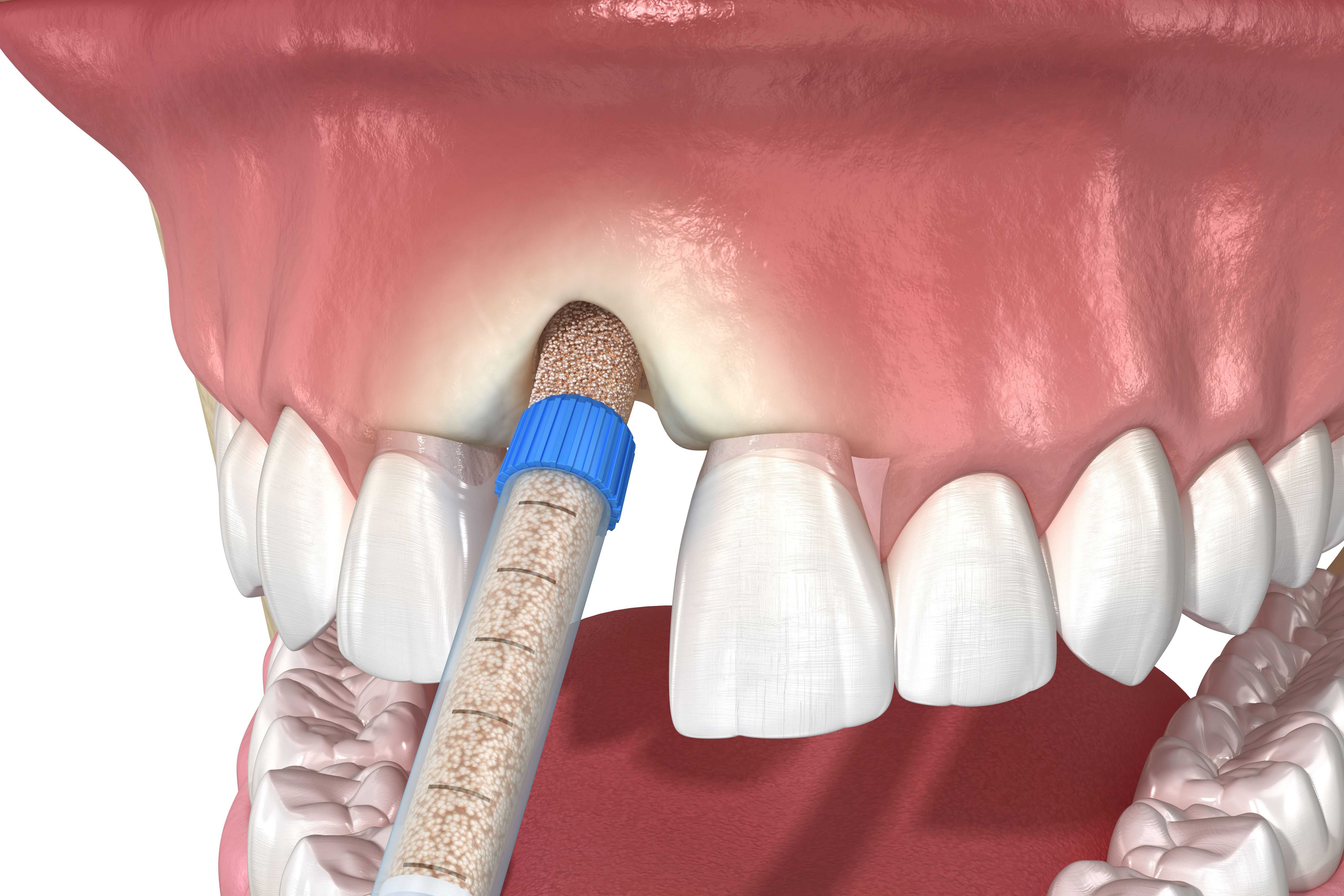 What Is Dental Bone Grafting & What To Expect