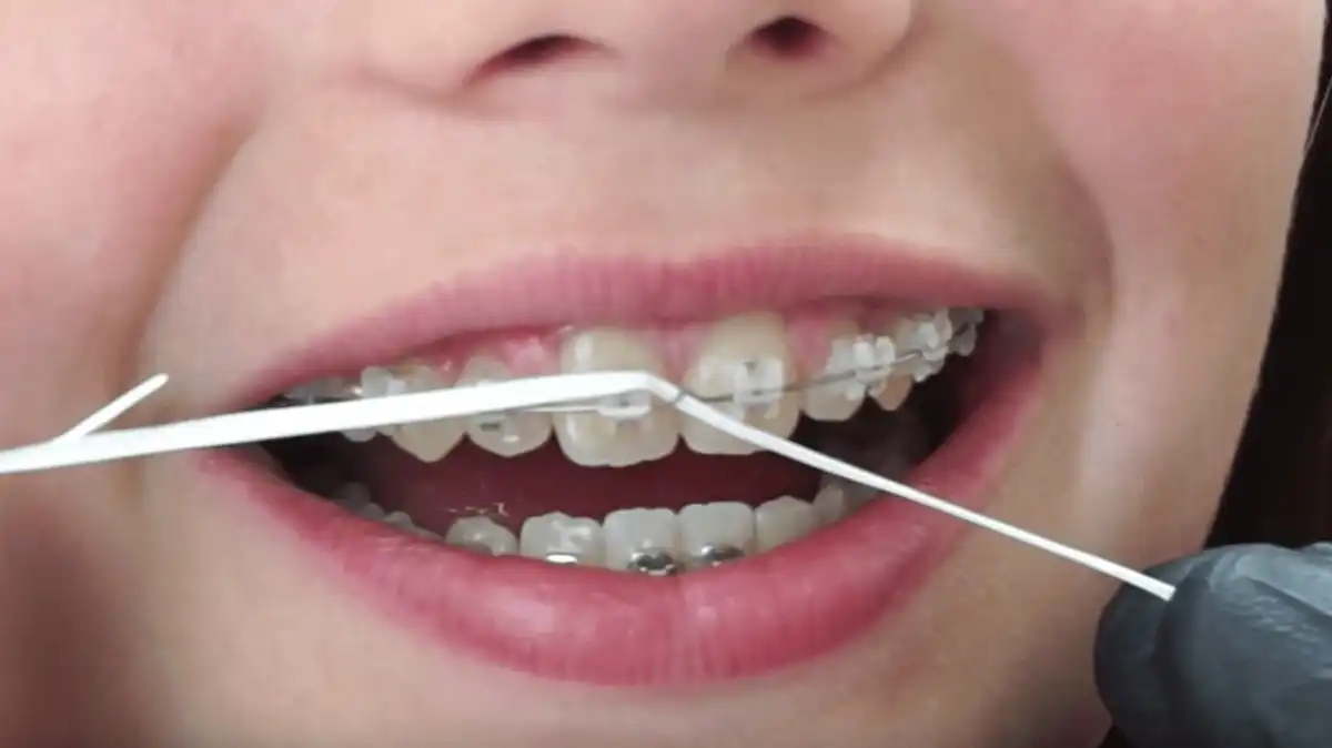 How To Take Care Of Braces | Water Flosser, Brushing, & More