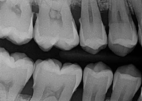 How to Take PERFECT Dental X-rays! 7 Tips and Tricks  