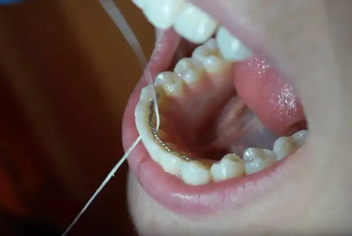 Flossing Tricks for Permanent Retainers