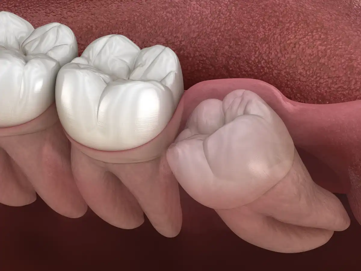 8 Warning Signs for Impacted Wisdom Teeth & 4 Impaction Type 
