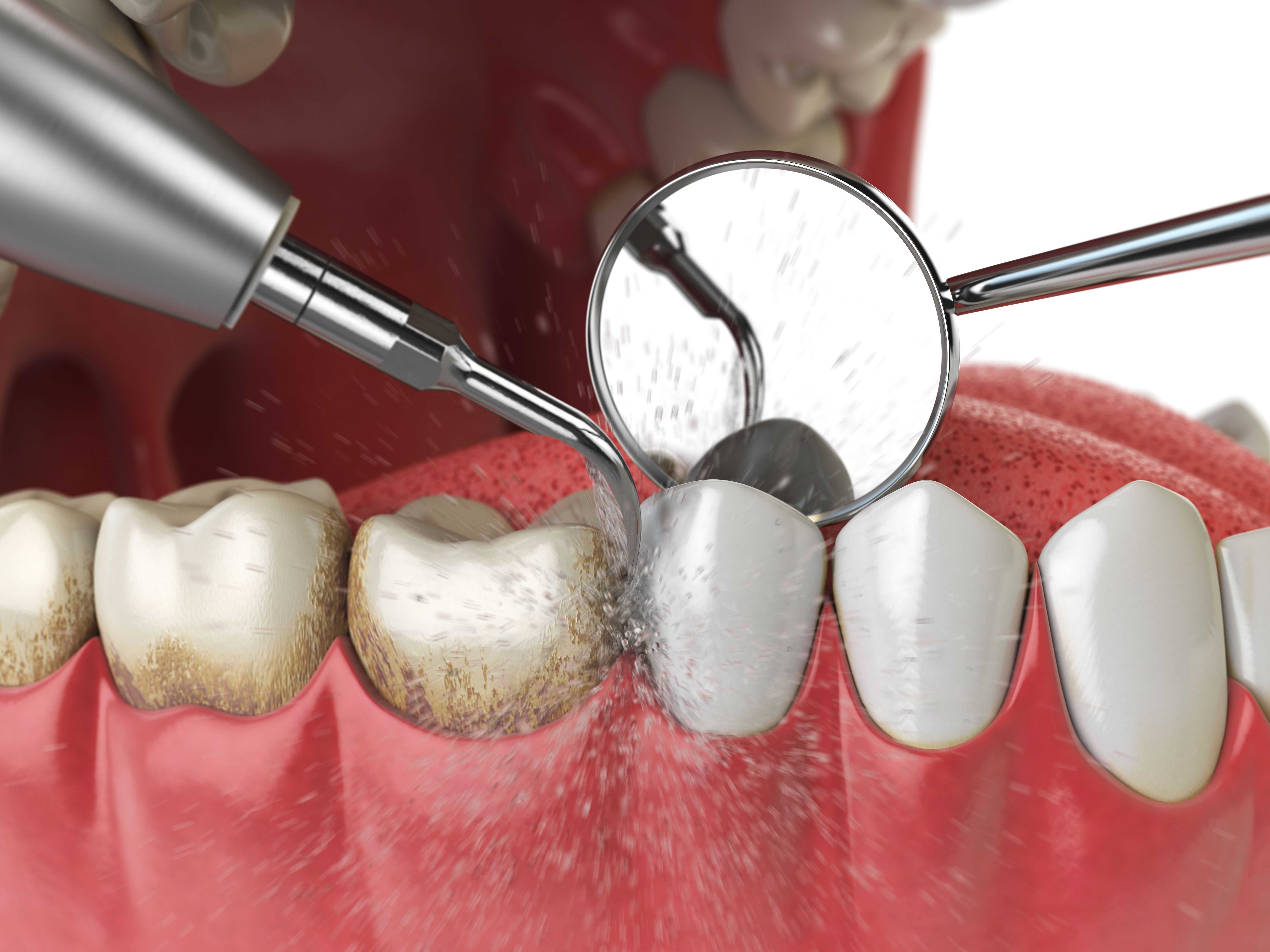 5 Types of Dental Cleanings