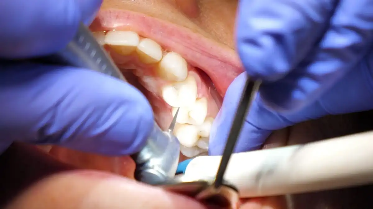Tooth Fillings | What to Expect, Types, And Care