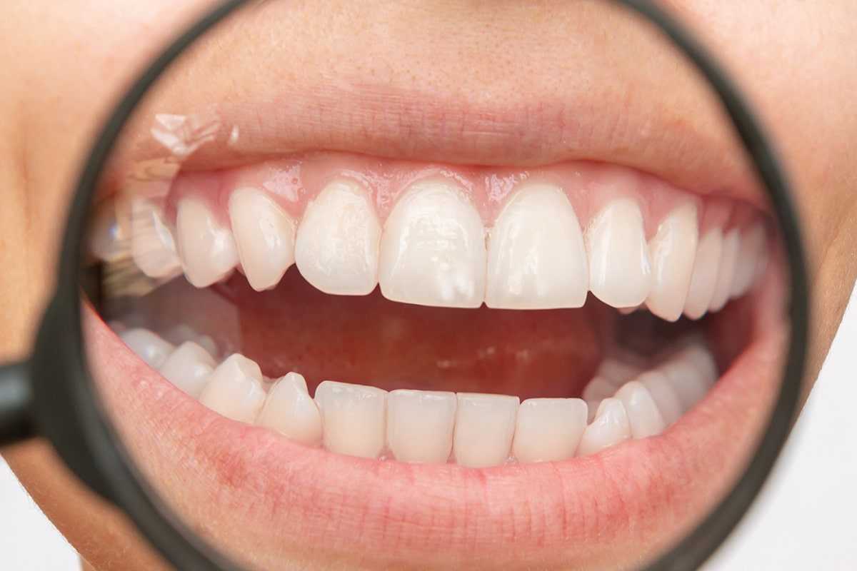 7 Signs You Have Fluorosis & What To Do About It