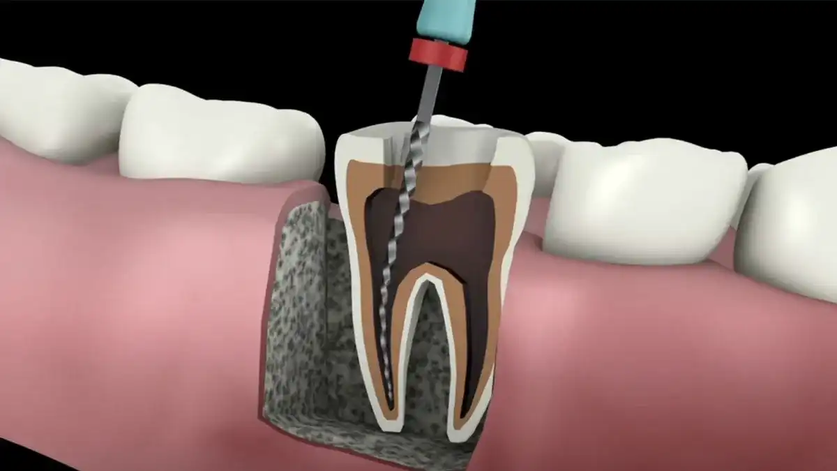 How Long Does A Root Canal Take?