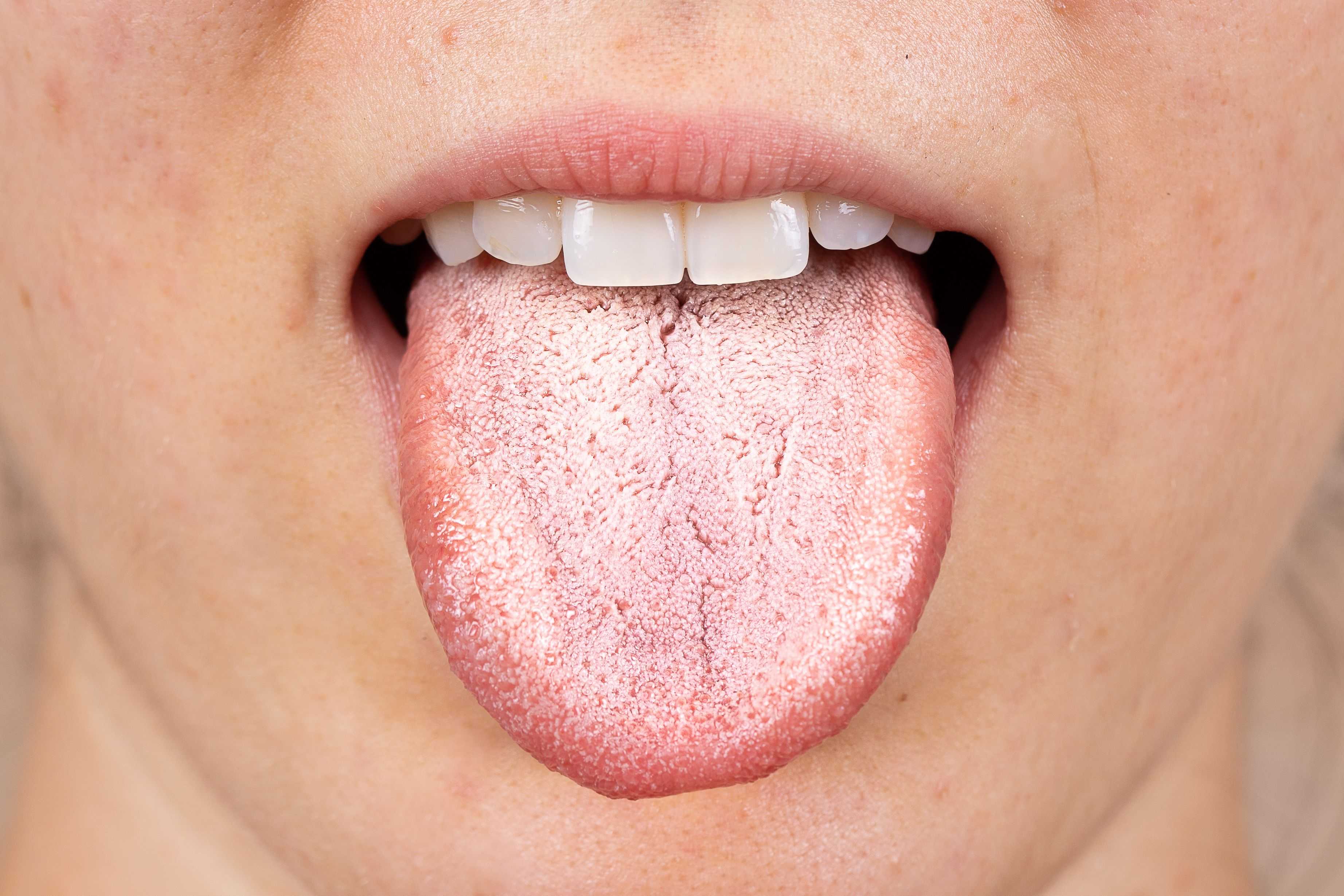 11 Reasons For A White Tongue & Treatments