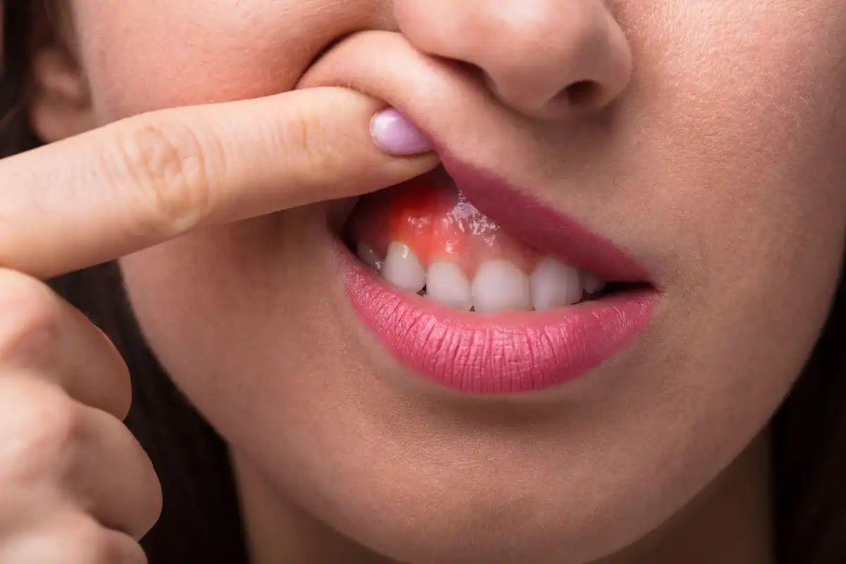 Gum Disease: Symptoms, Treatment, and Risks