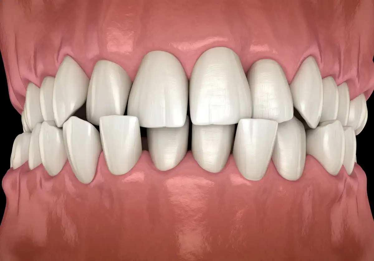 What Is A Crossbite & How Do You Correct It