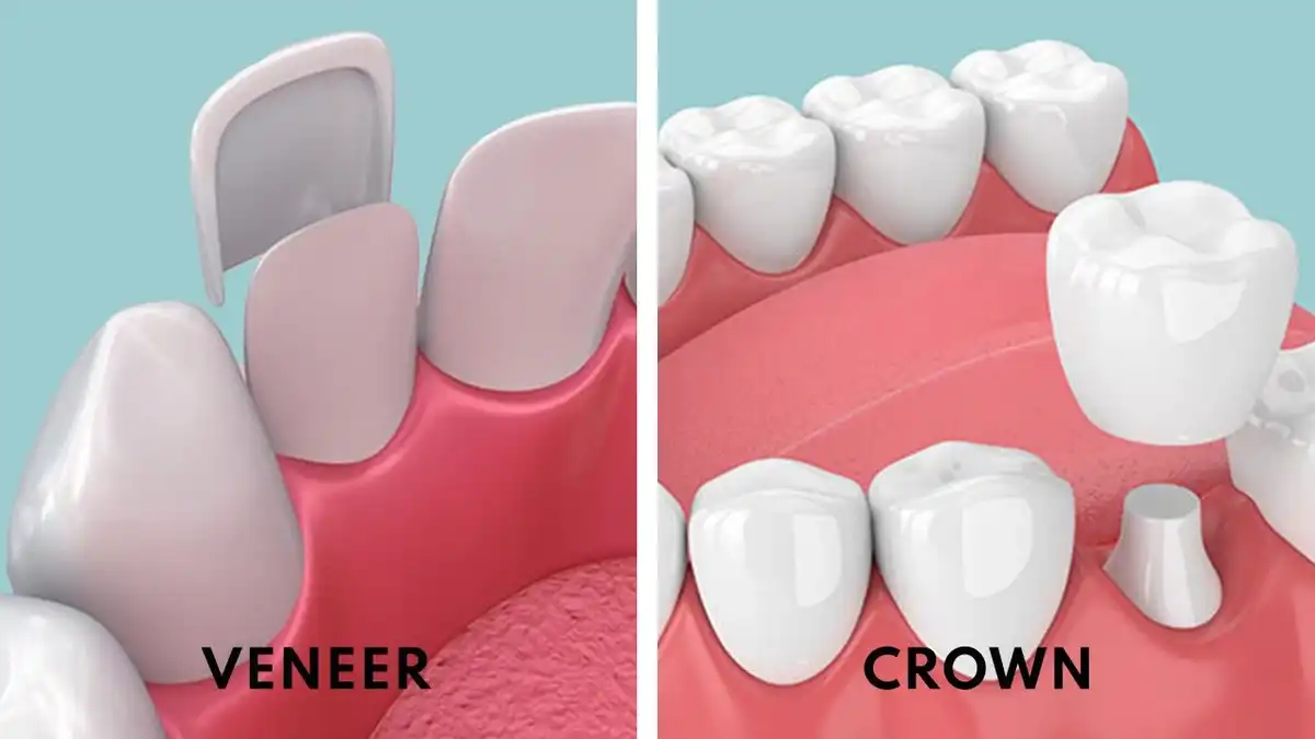 Veneers vs. Crowns: What's the Difference & Which is Better