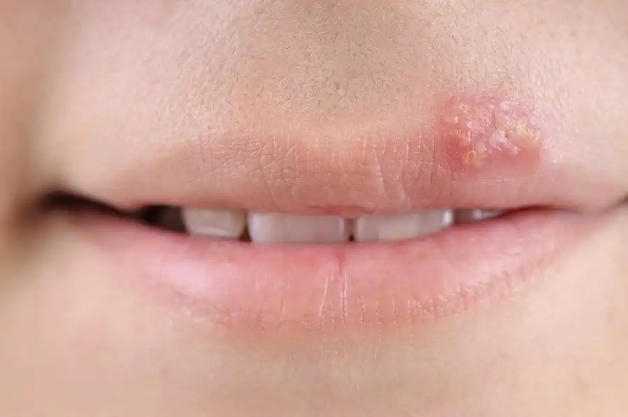 How To Get Rid Of A Cold Sore