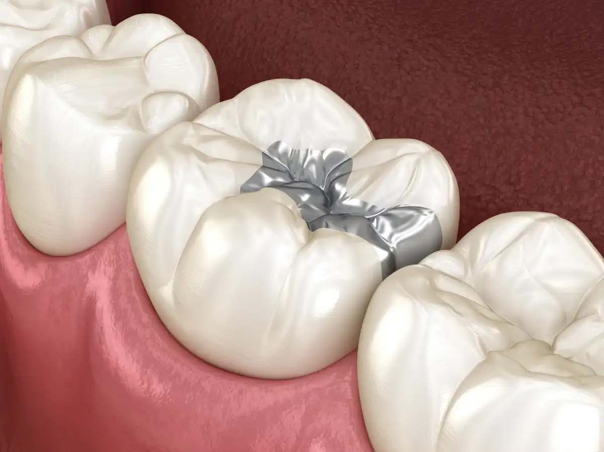 The Truth About Silver Fillings | Risks & Side Effects 