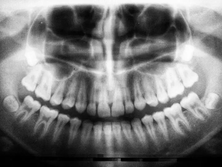 Are Dental X-Rays Safe?