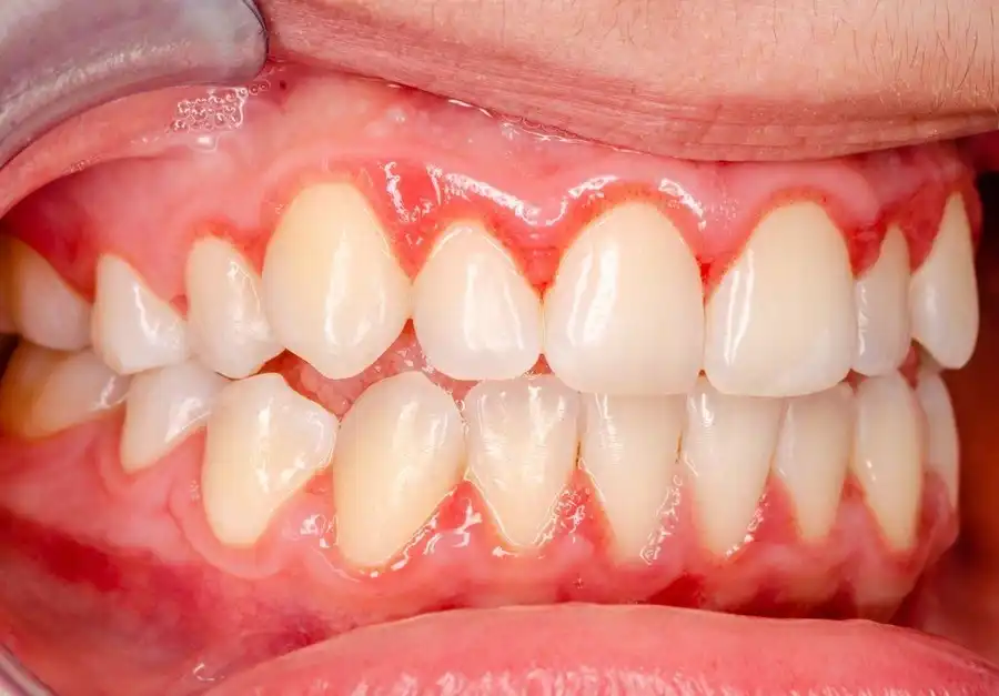 11 Reasons Why Your Gums Are Itchy