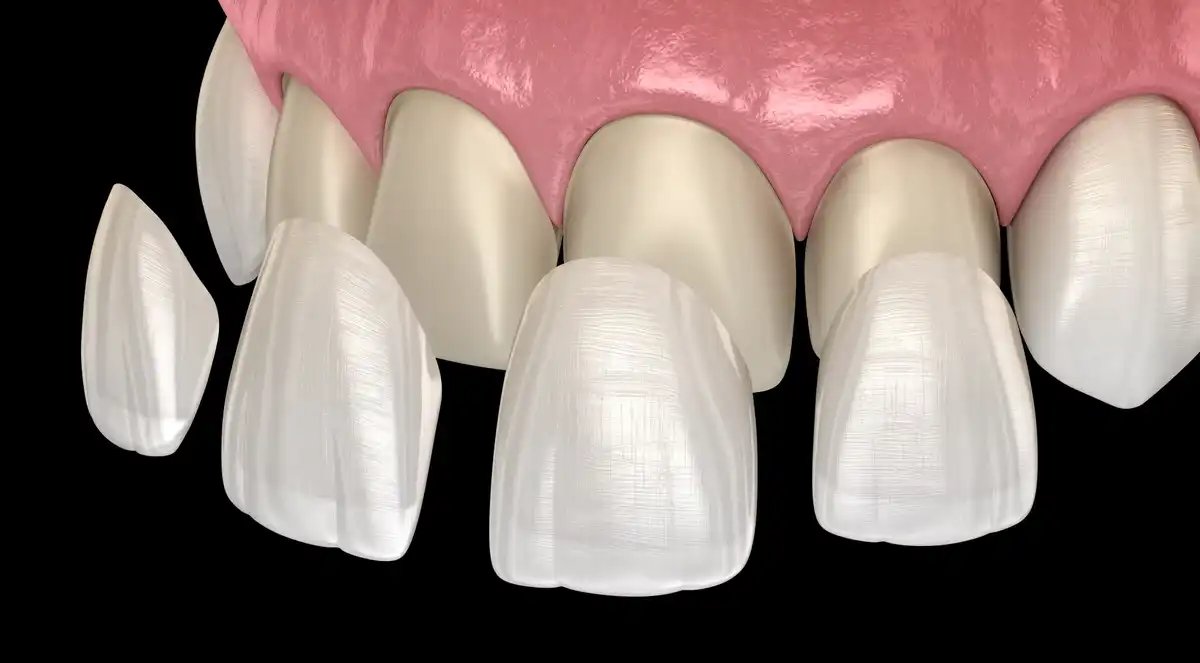 What Are Dental Veneers & How Do They Work?