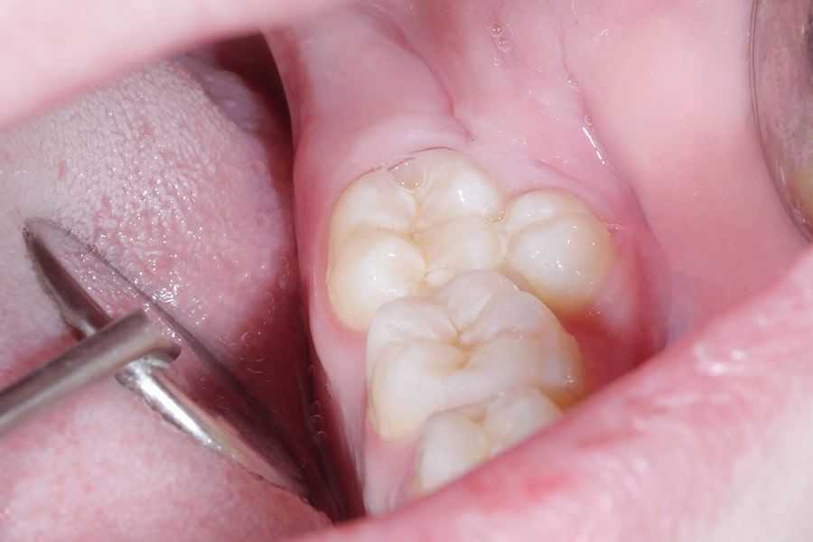 Supernumerary Teeth