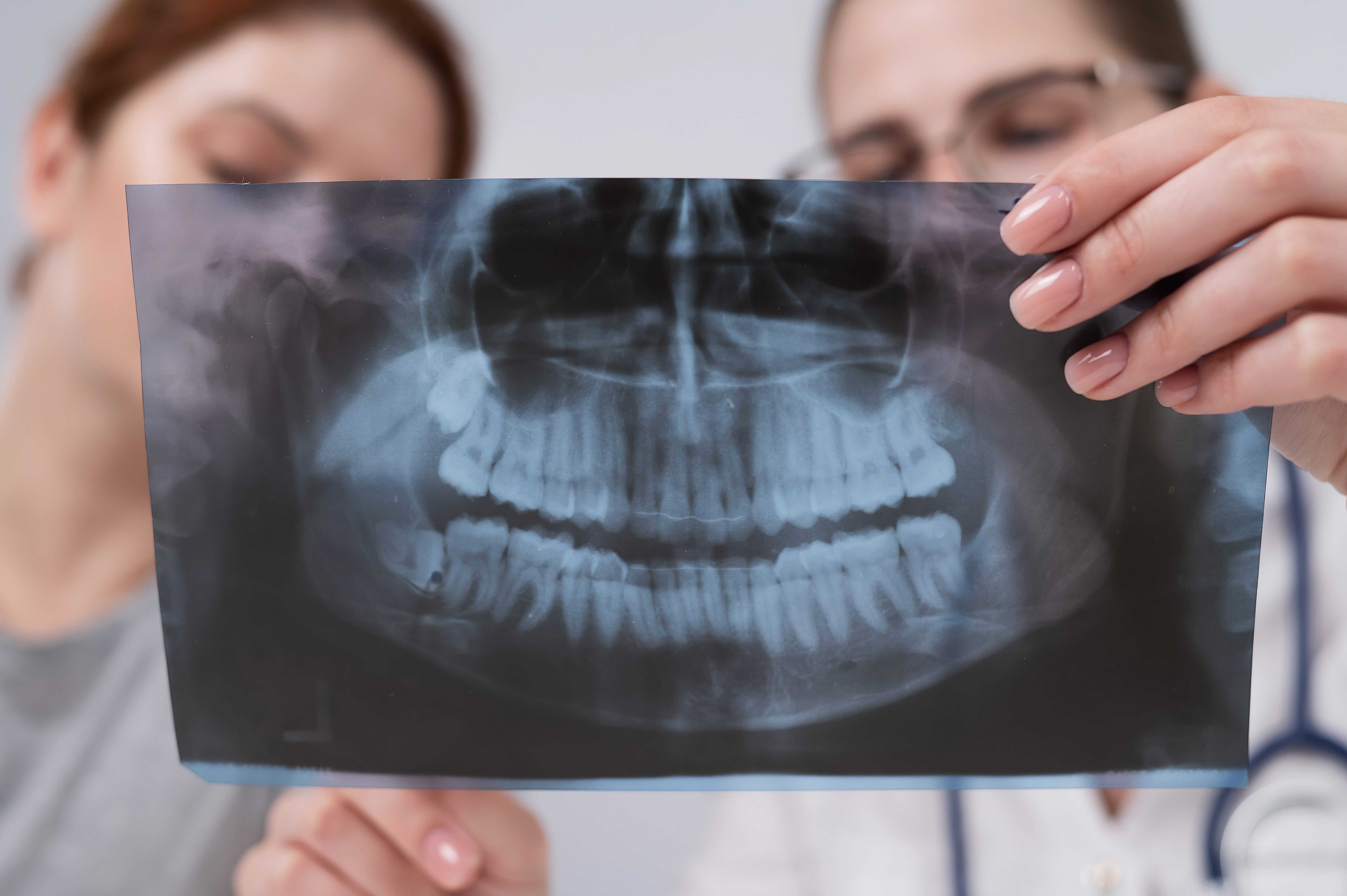 8 Signs Of Root Resorption & Resorbing Tooth