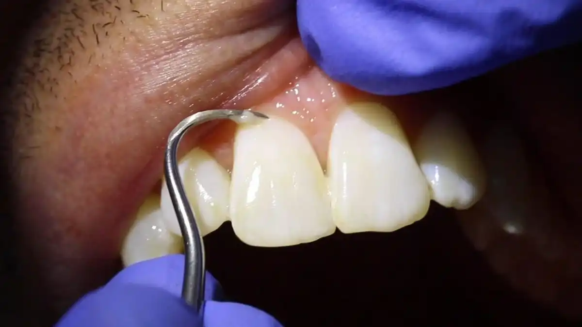 Hand Scaling Tips for Dental Hygienist 