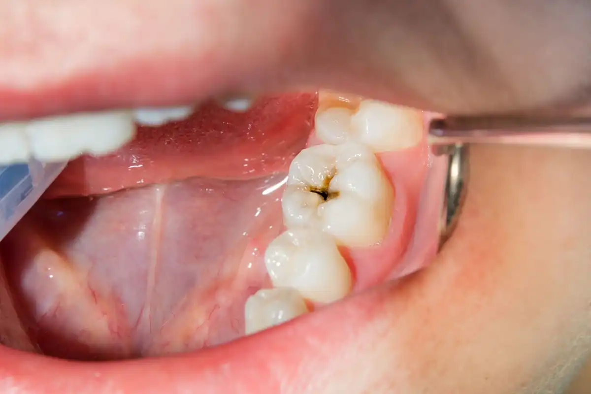 Cavities & Tooth Decay | Everything You Need To Know