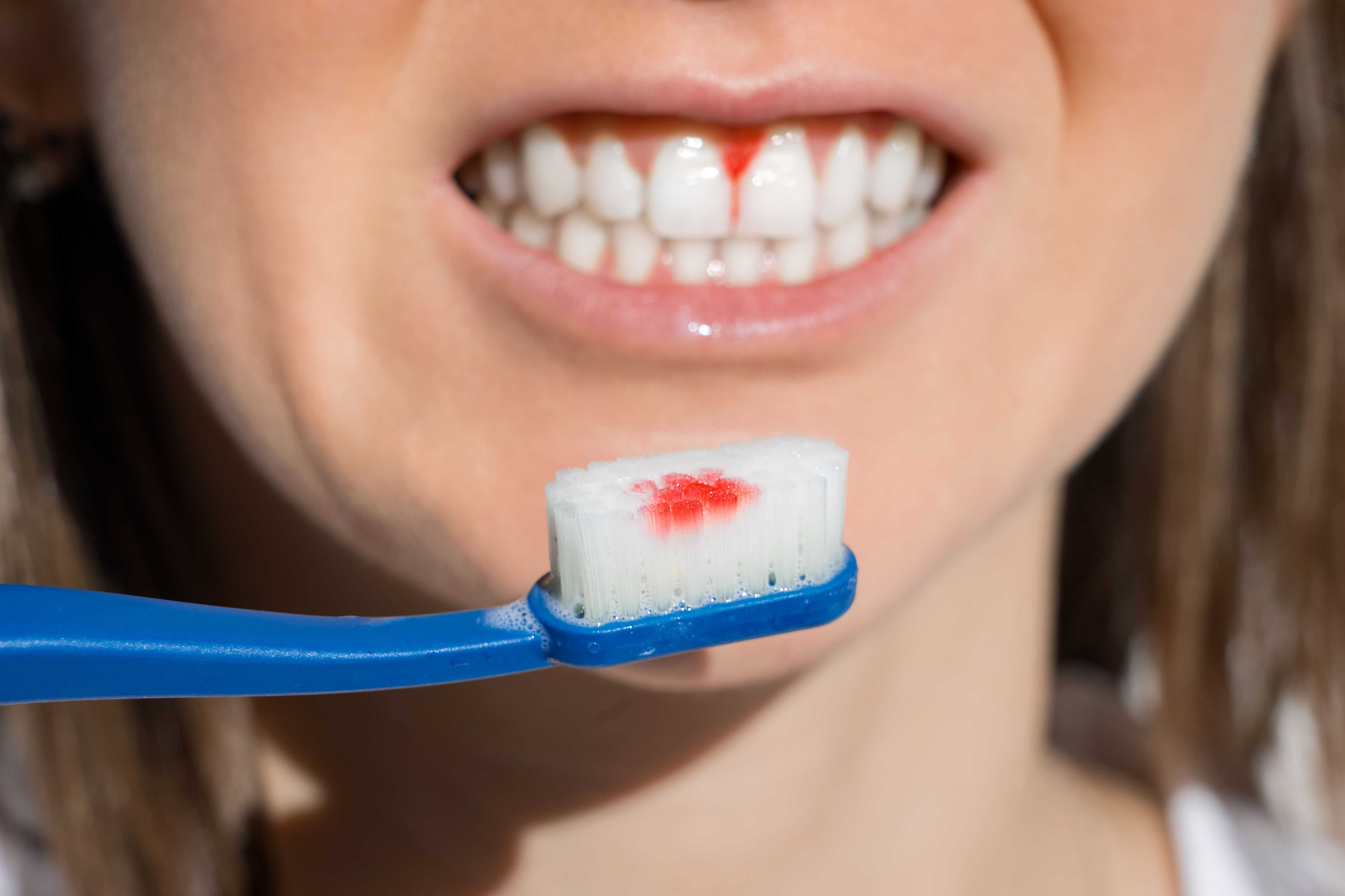 9 Ways To Stop Bleeding Gums From Brushing Teeth 