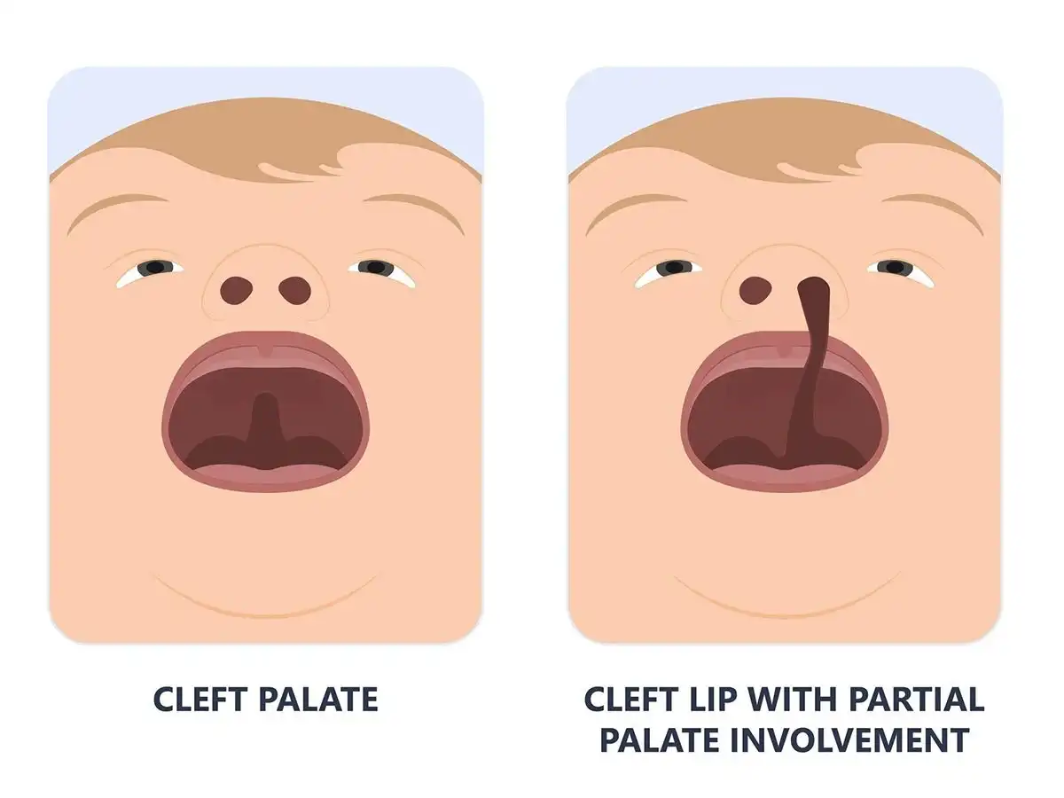 Cleft Palate