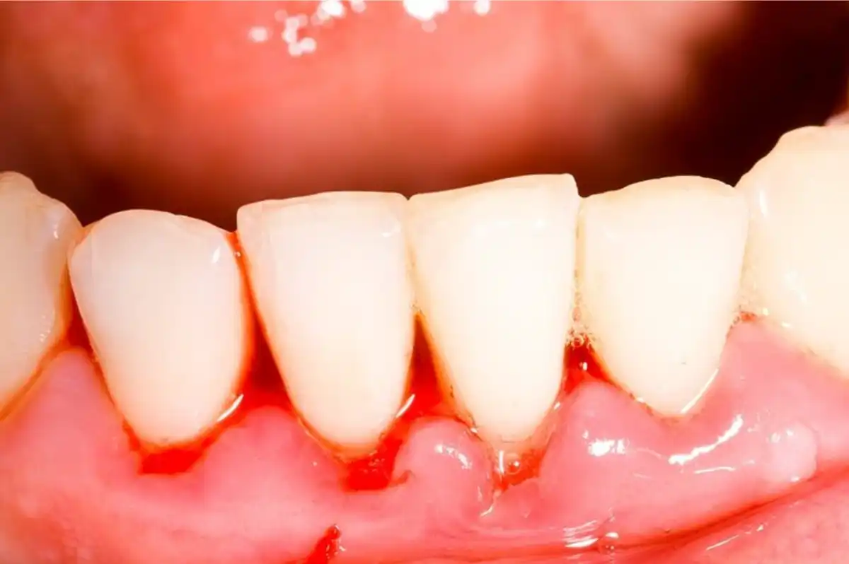 Why Are My Gums Swollen? | Causes, Treatment, & Prevention