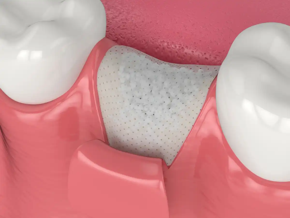 8 Signs Of Failed Dental Bone Graft 