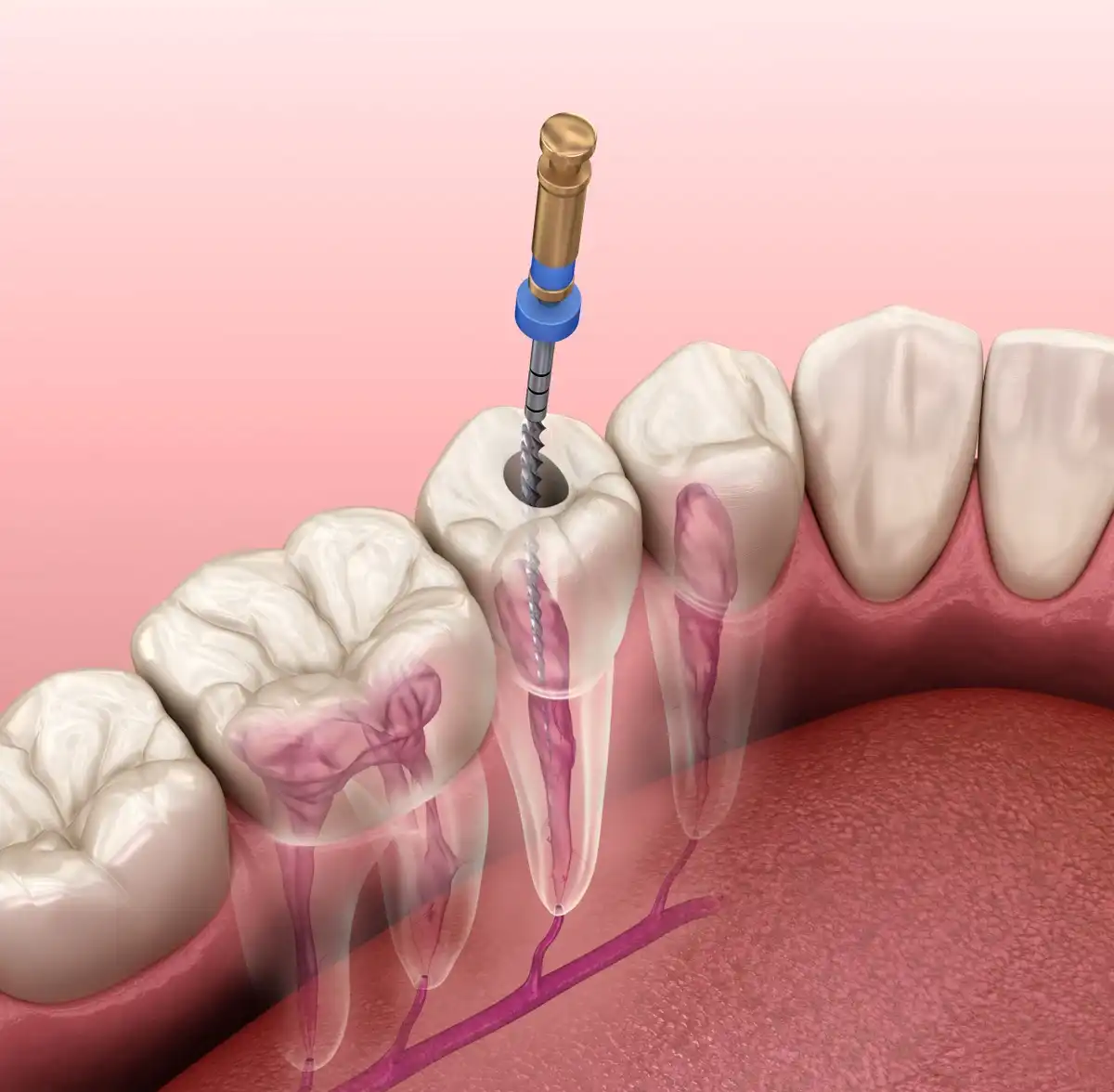 Step by Step Dental Filling Procedure