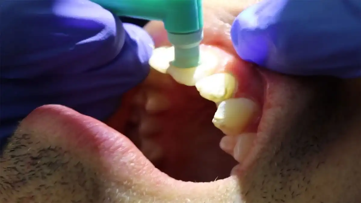 Teeth Polishing