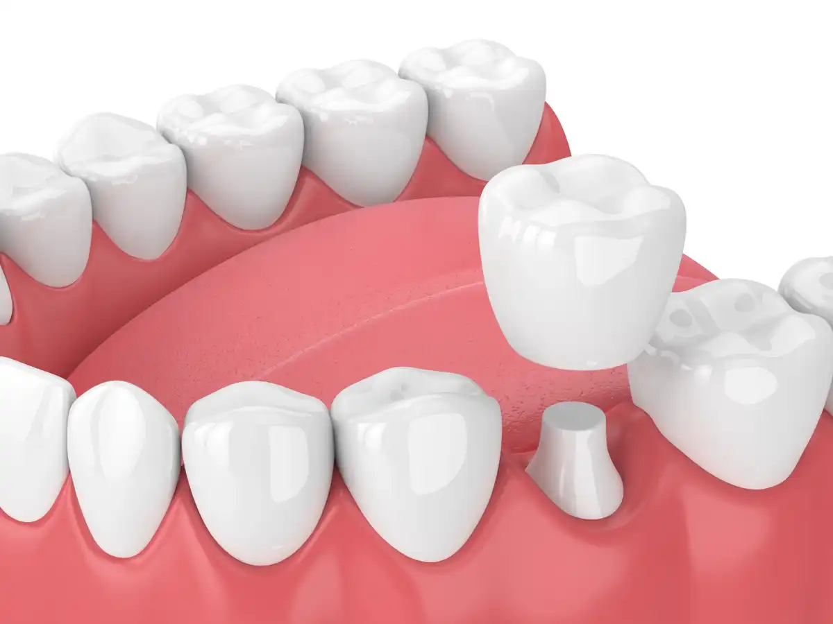 Dental Crowns: 5 Types, Procedure & Cost  