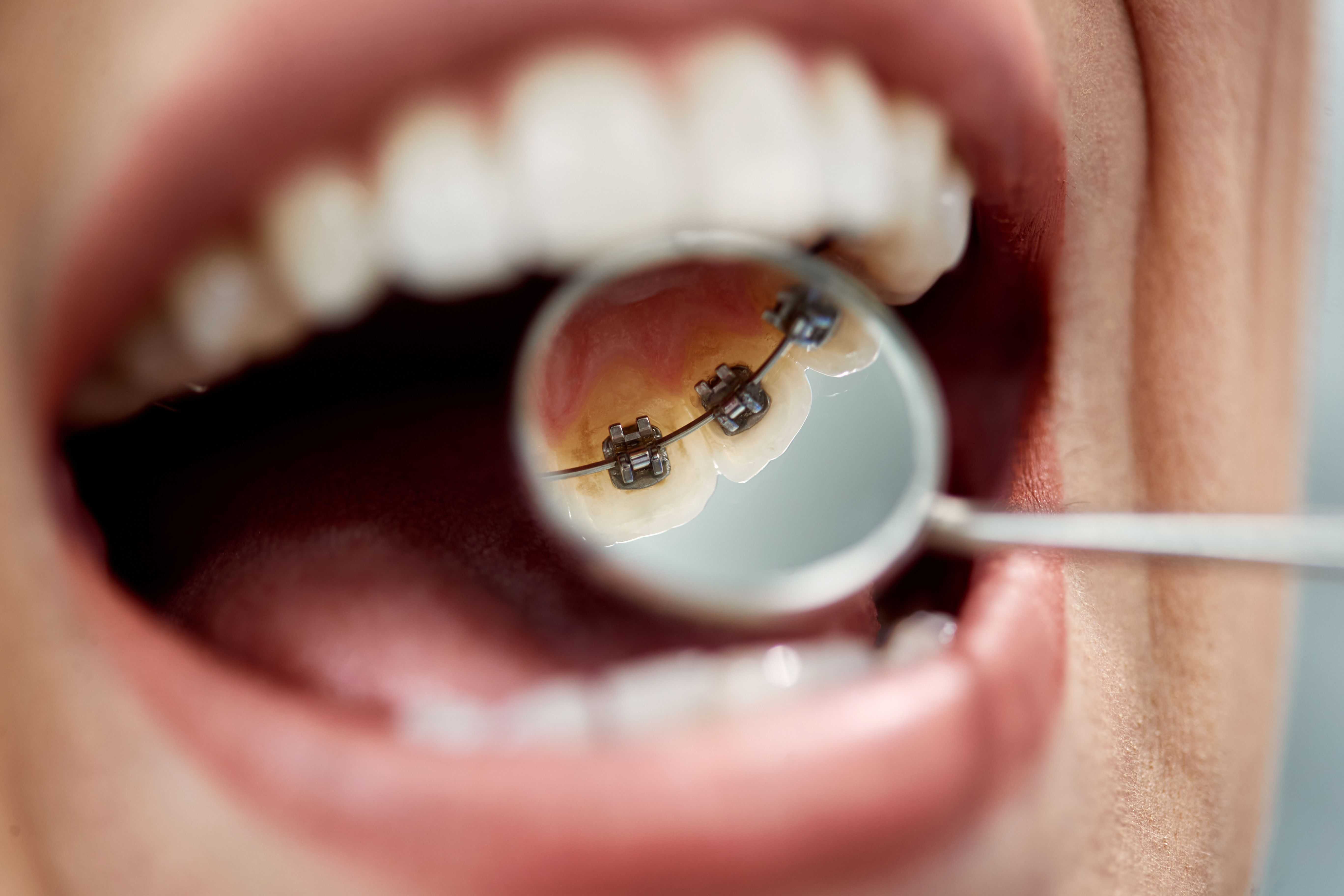 7 Things To Know About Lingual Braces: Pros, Cons & Cost 