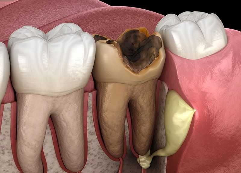 5 Signs Your Tooth Is Dead & What To Do About It 
