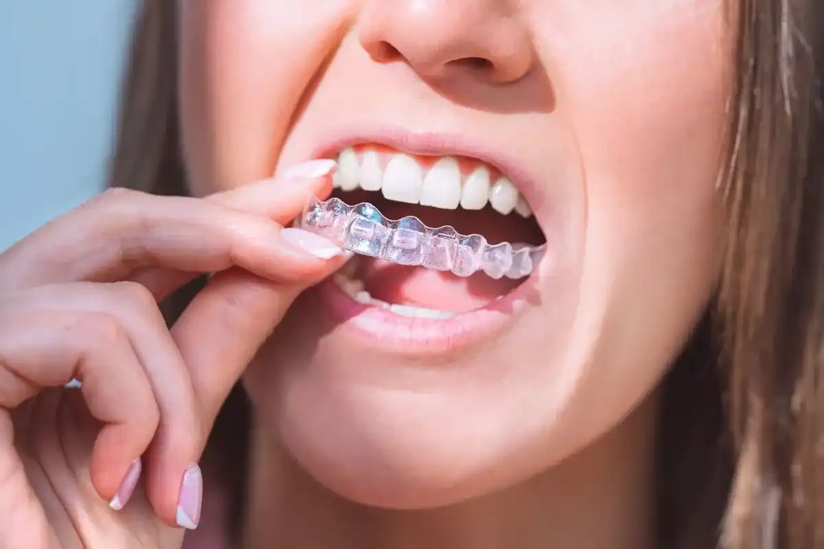 How long does Invisalign take to make your teeth beautiful? – TruCare  Dentistry