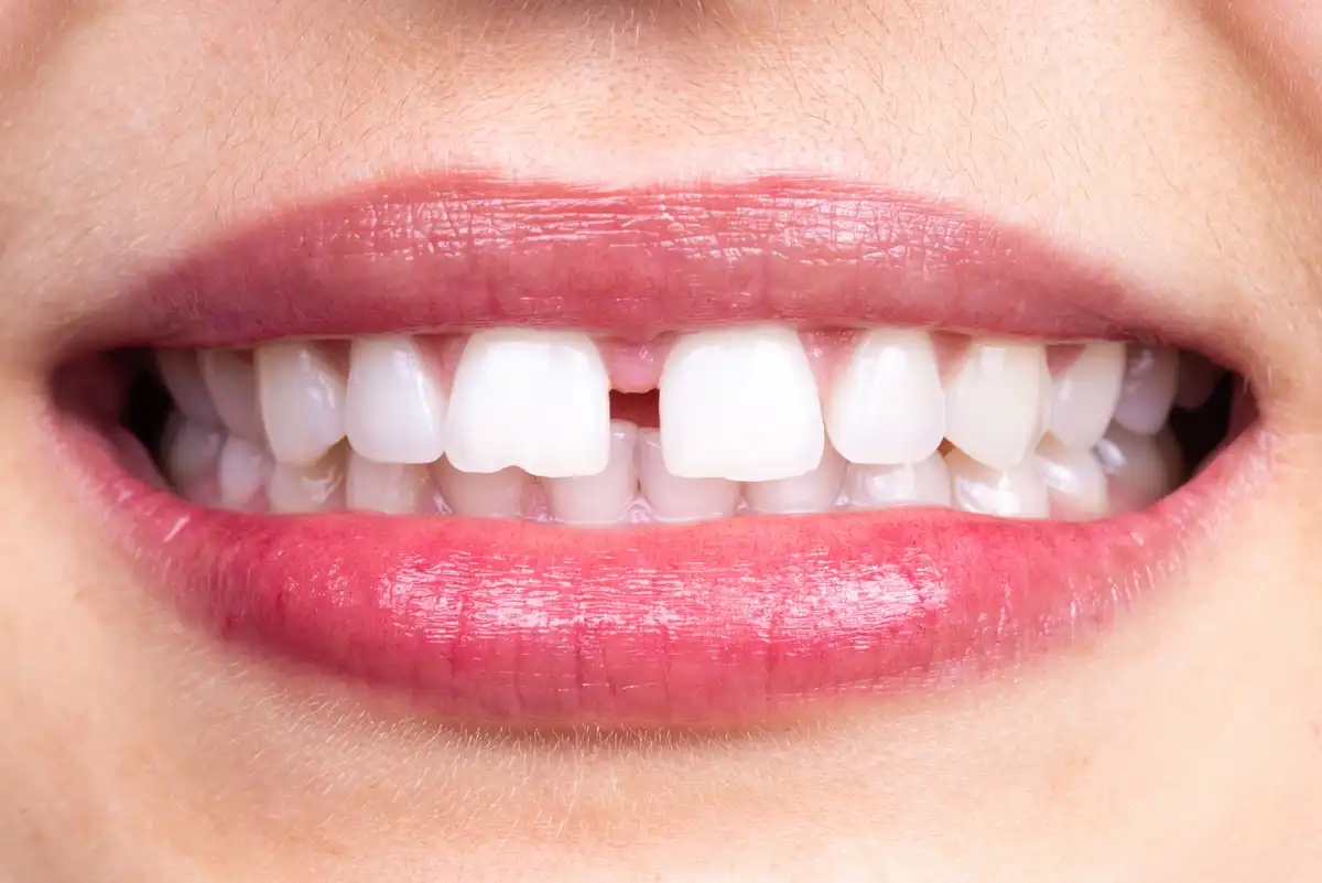 What is a Diastema & Should You Fill Your Gap Teeth