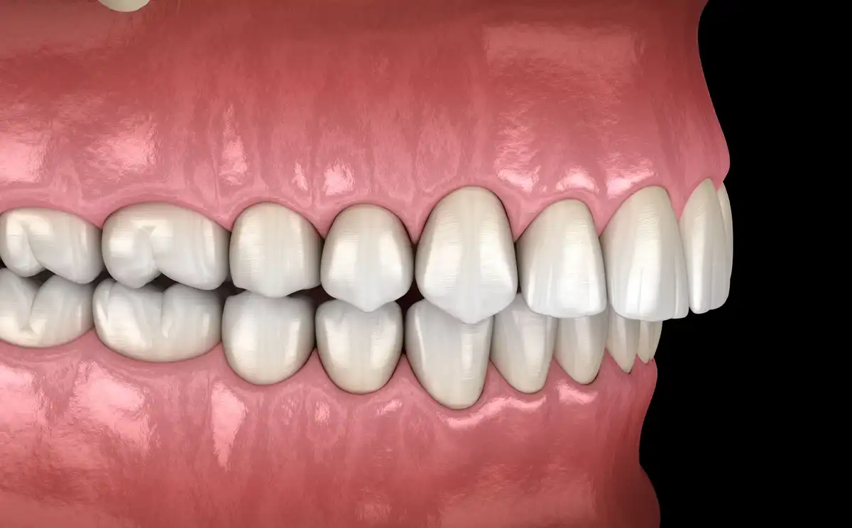 What is an Overbite & How is it Corrected?