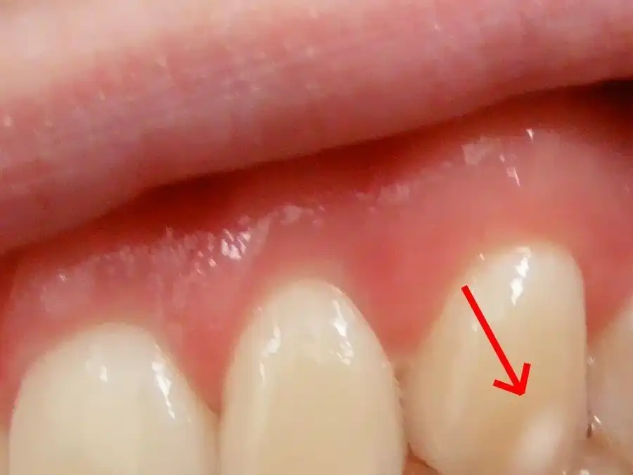 9 Reasons Why You Have White Spots On Your Teeth