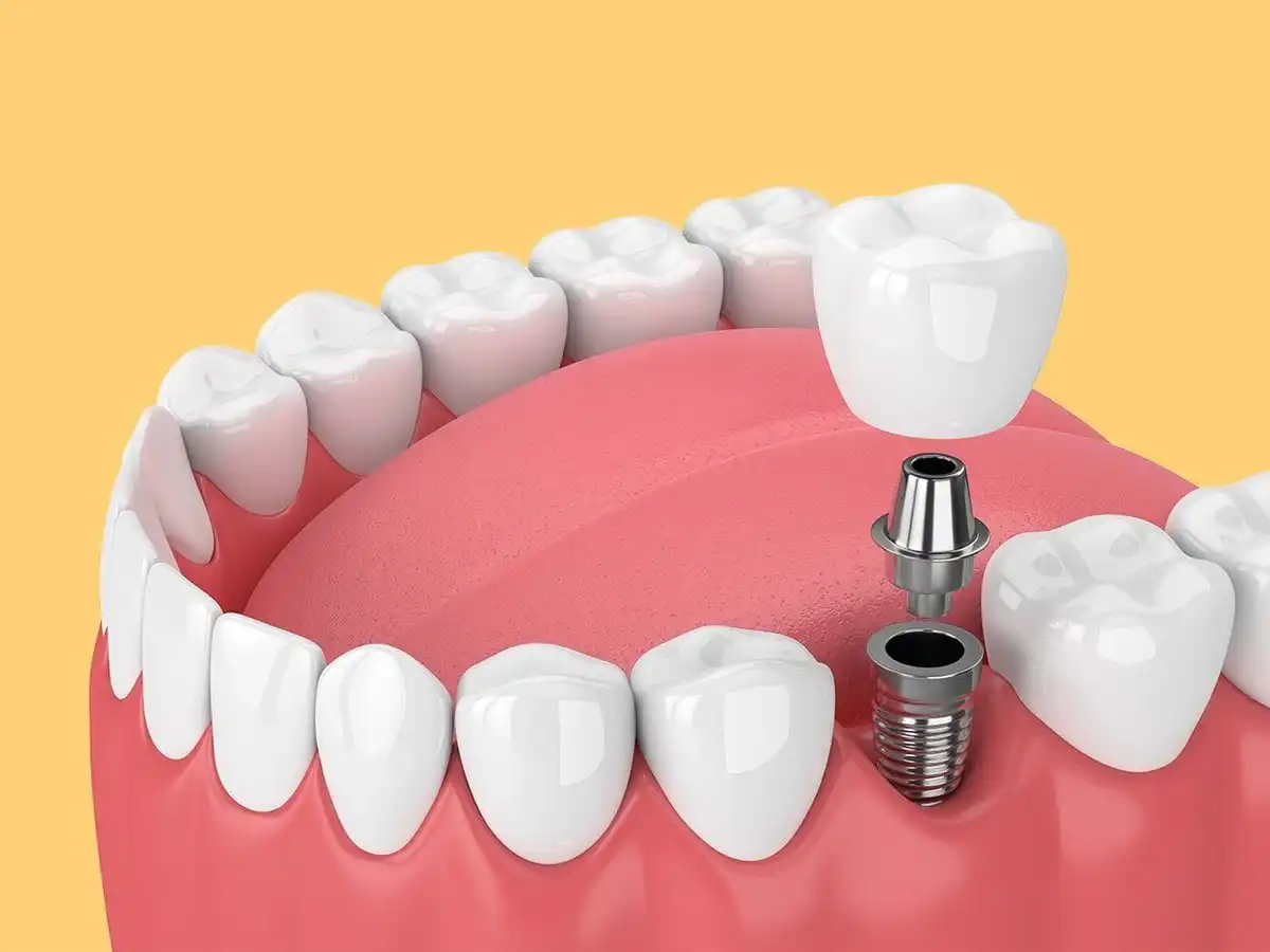 How Much Are Dental Implants? Implant Costs & What to Expect 