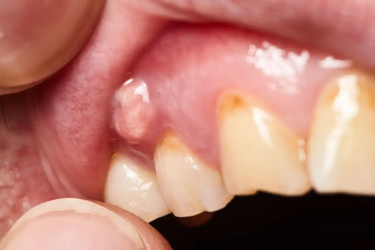 9 Reasons for a Boil or Bump on Gums article description 