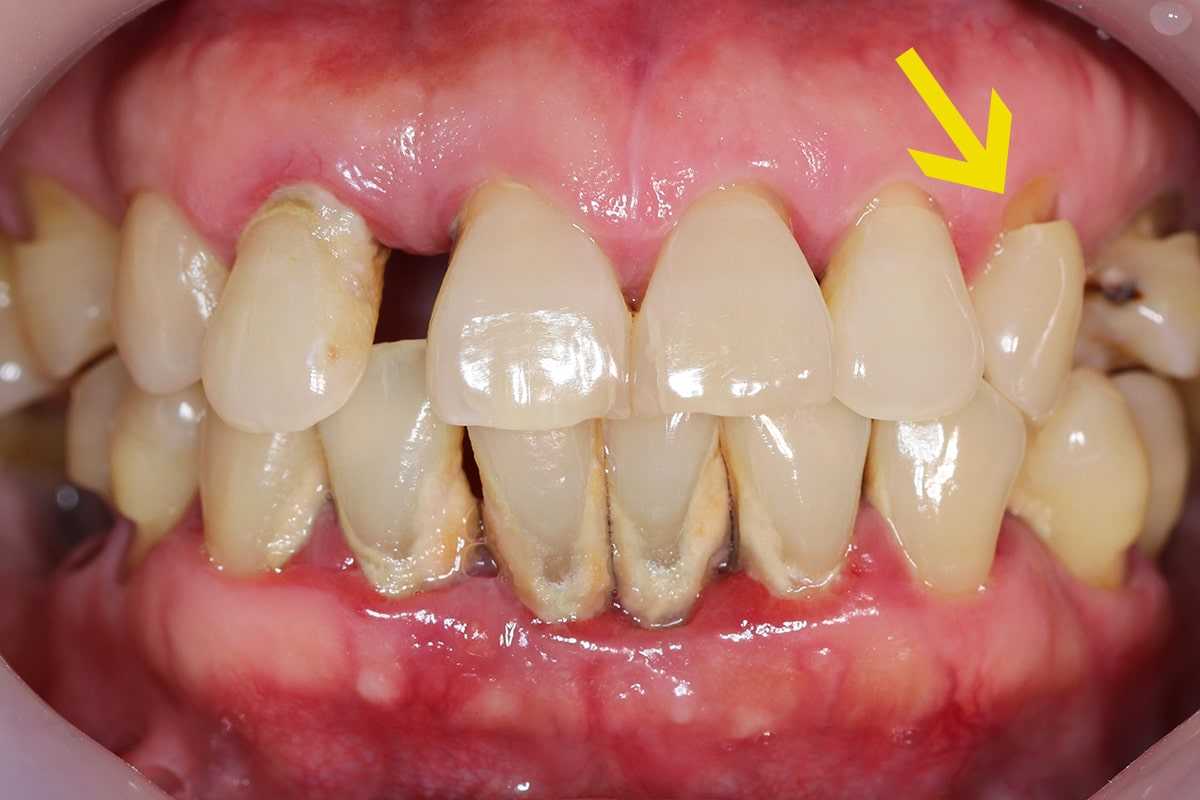 6 Reasons For Gumline Cavities & How To Fix Them