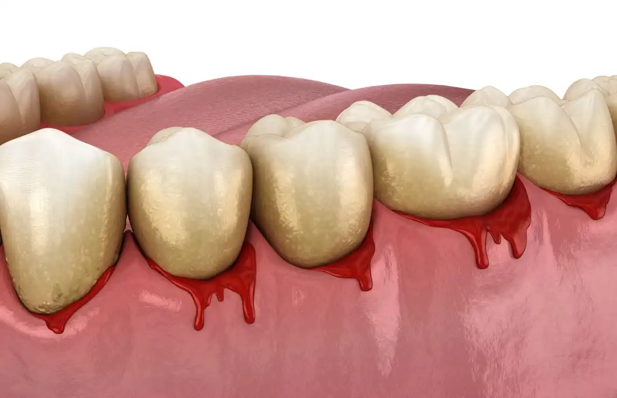Bleeding Gums: Causes, Treatment, And Prevention
