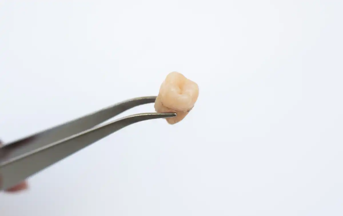 Wait, Can Wisdom Teeth Grow Back After They're Removed?
