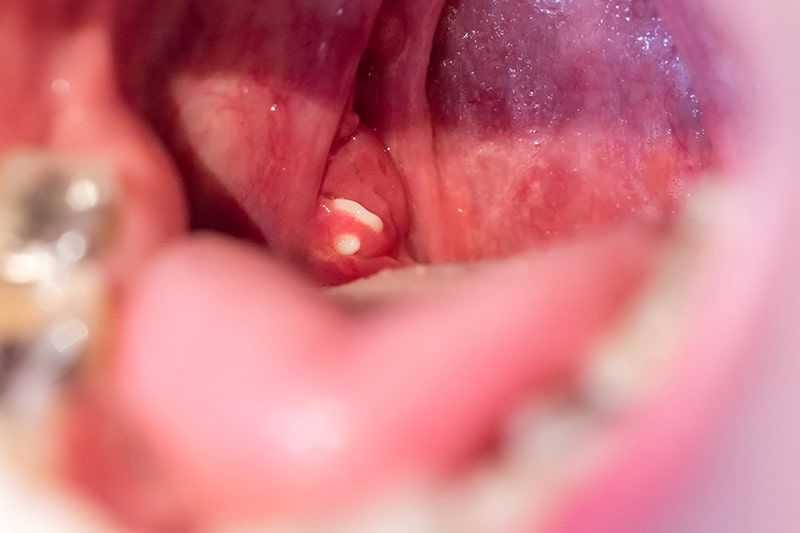 Tonsil Stones