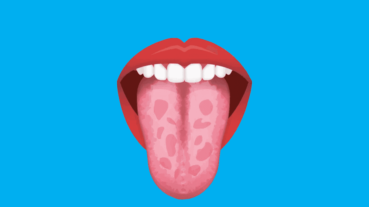 8 Reasons for Geographic Tongue & How To Treat It