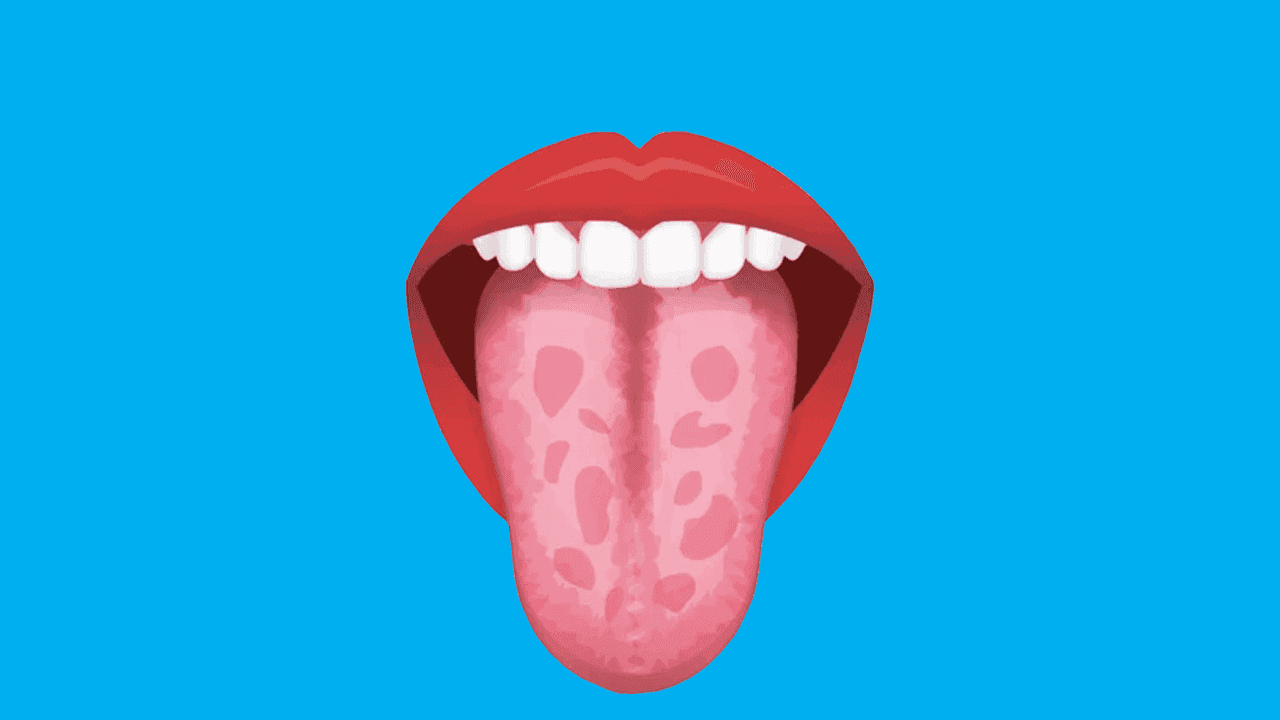 8 Reasons For Geographic Tongue And How To Treat It