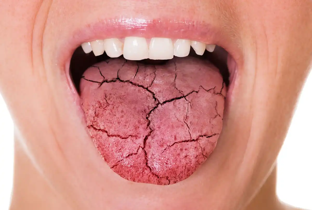 Dry Mouth: Causes, Treatment, And Prevention
