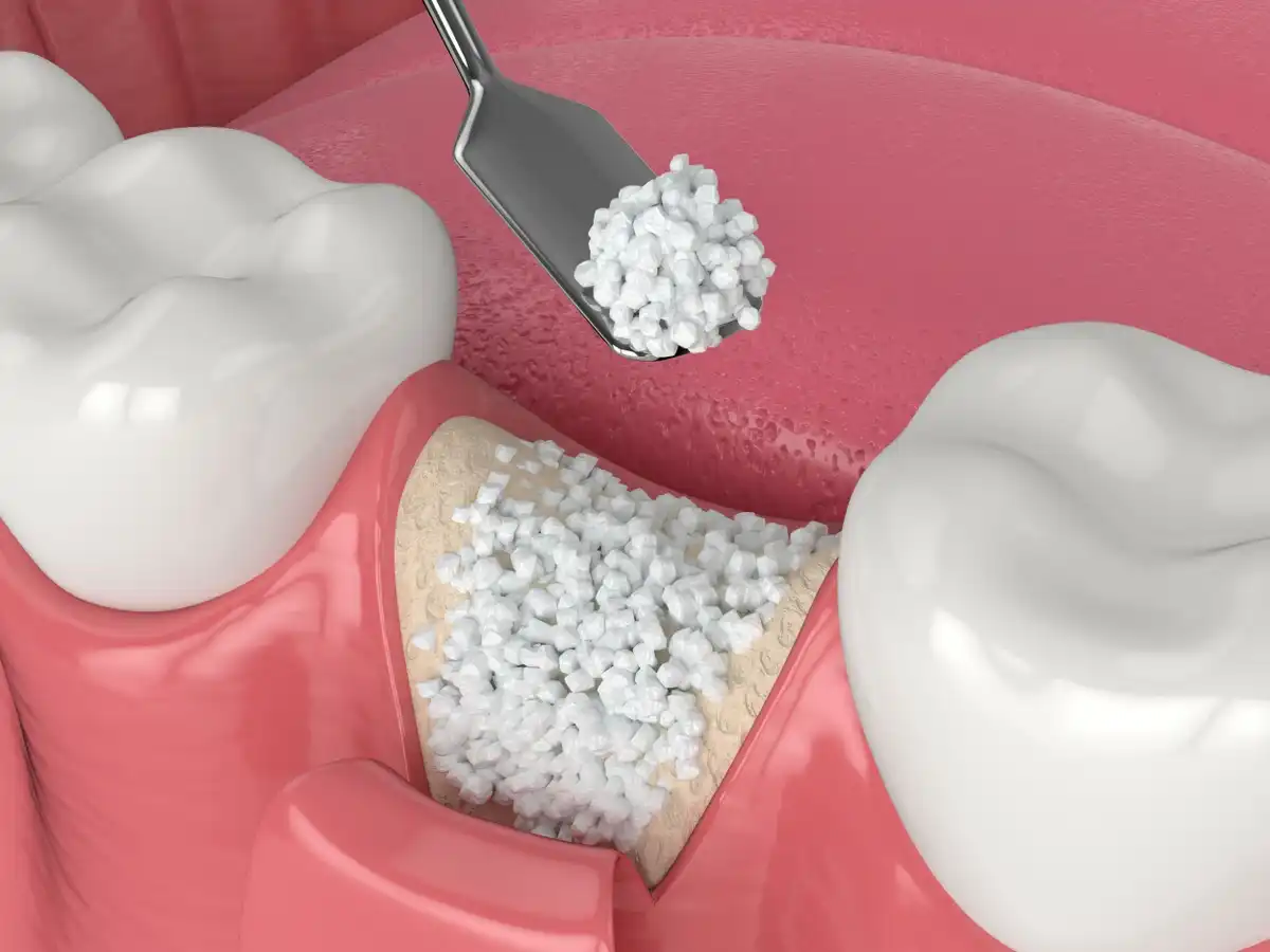 Cost For A Dental Bone Graft | 4 Graft Types & Costs