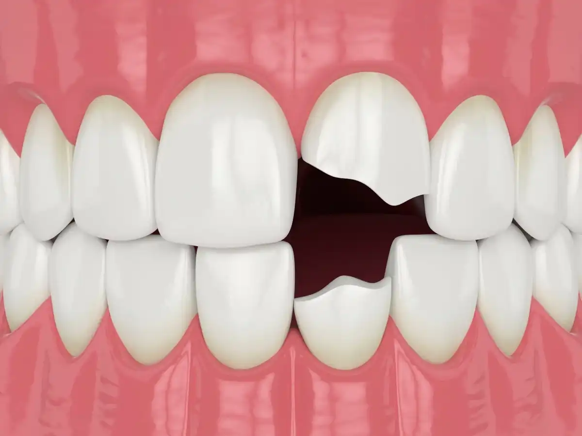 How to Fix a Chipped Tooth