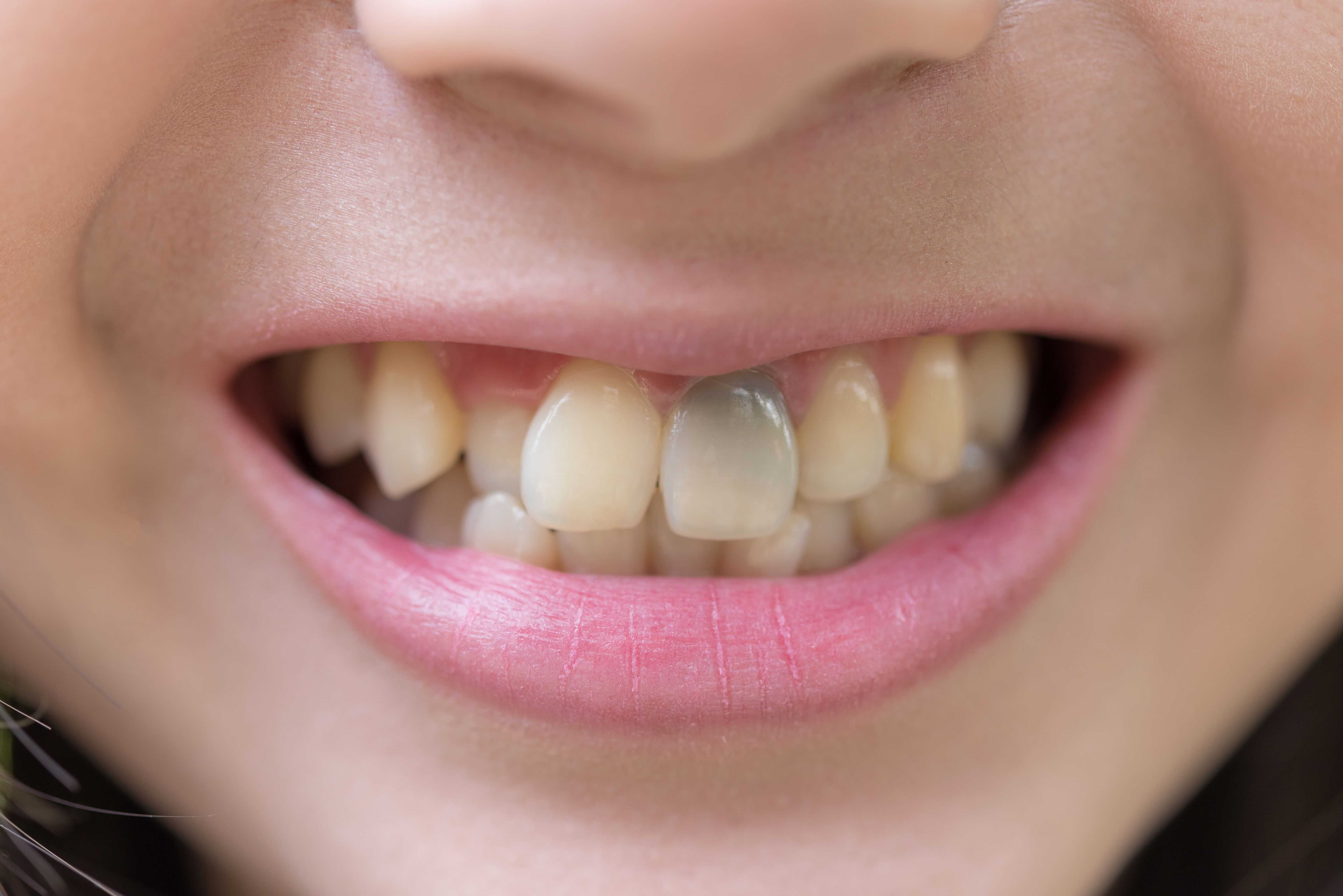 Can You Whiten A Dead Tooth or Dark Tooth?