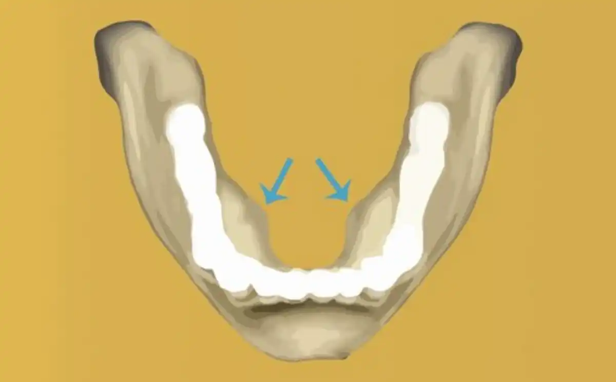 What are Mandibular Tori?